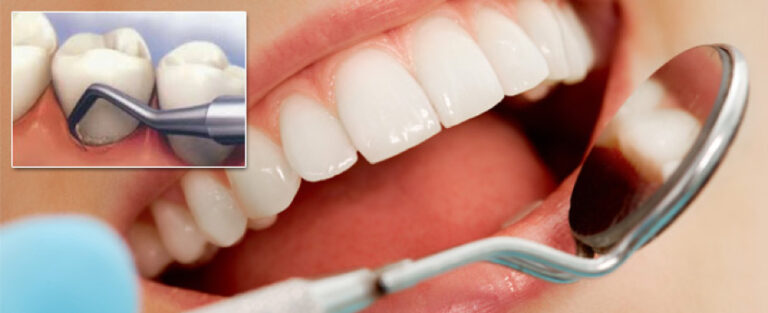 extractions St. Matthews KY