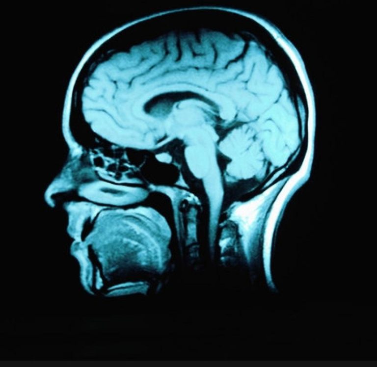 Average Settlement for a Severe Brain Injury in Dallas?