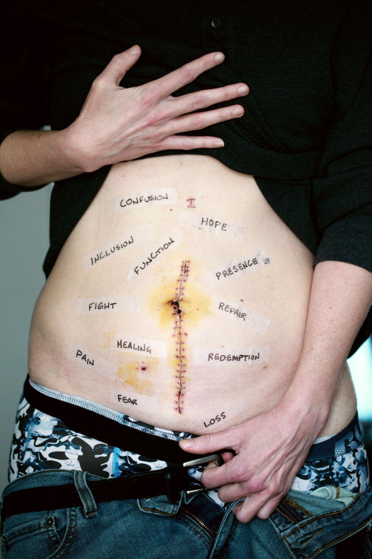 Weight Loss Surgery